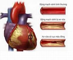 Kinh nghiệm điều trị máu nhiễm mỡ bằng thuốc nam